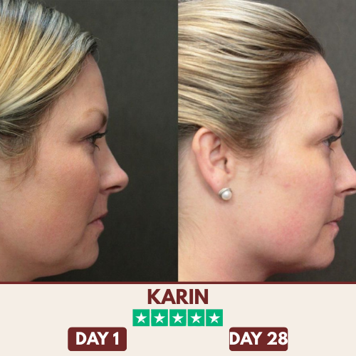 ChinShine™ Lift & Sculpt Mask