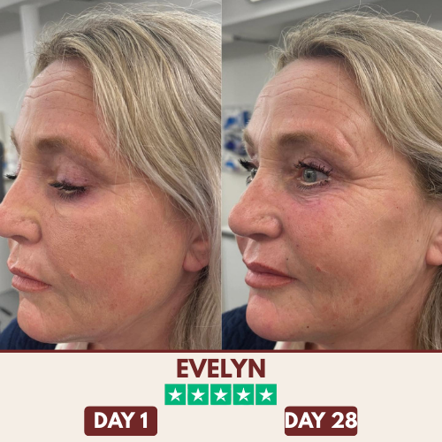 ChinShine™ Lift & Sculpt Mask